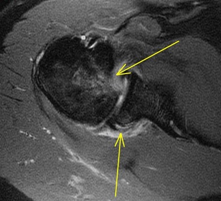 Figure 5 for case Reverse bankart and hill sachs lesions